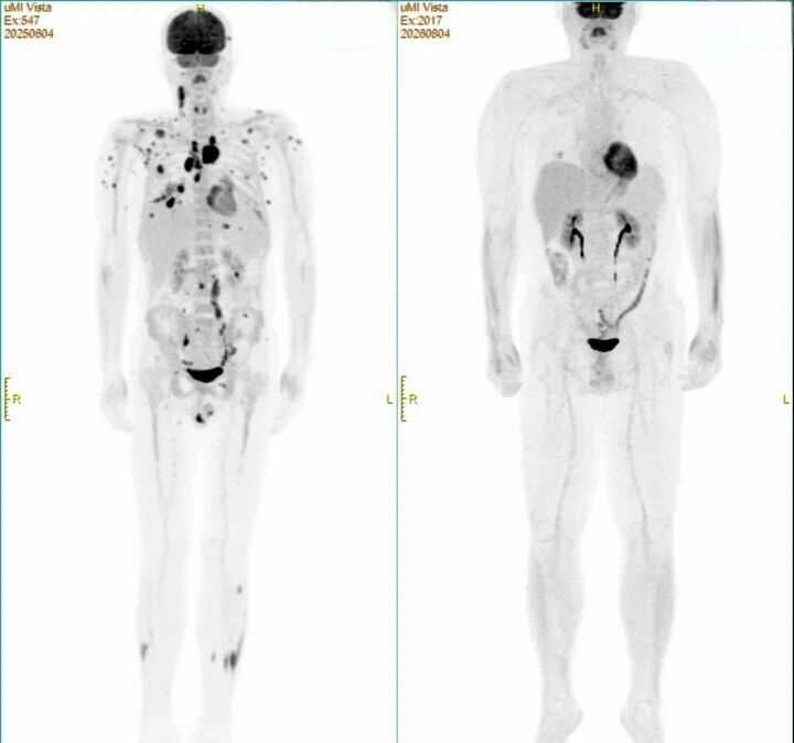Mr Yang's PET/CT comparison as reproduced in the original article; his three-month assessment after CD79b CAR-T was reported as complete remission.